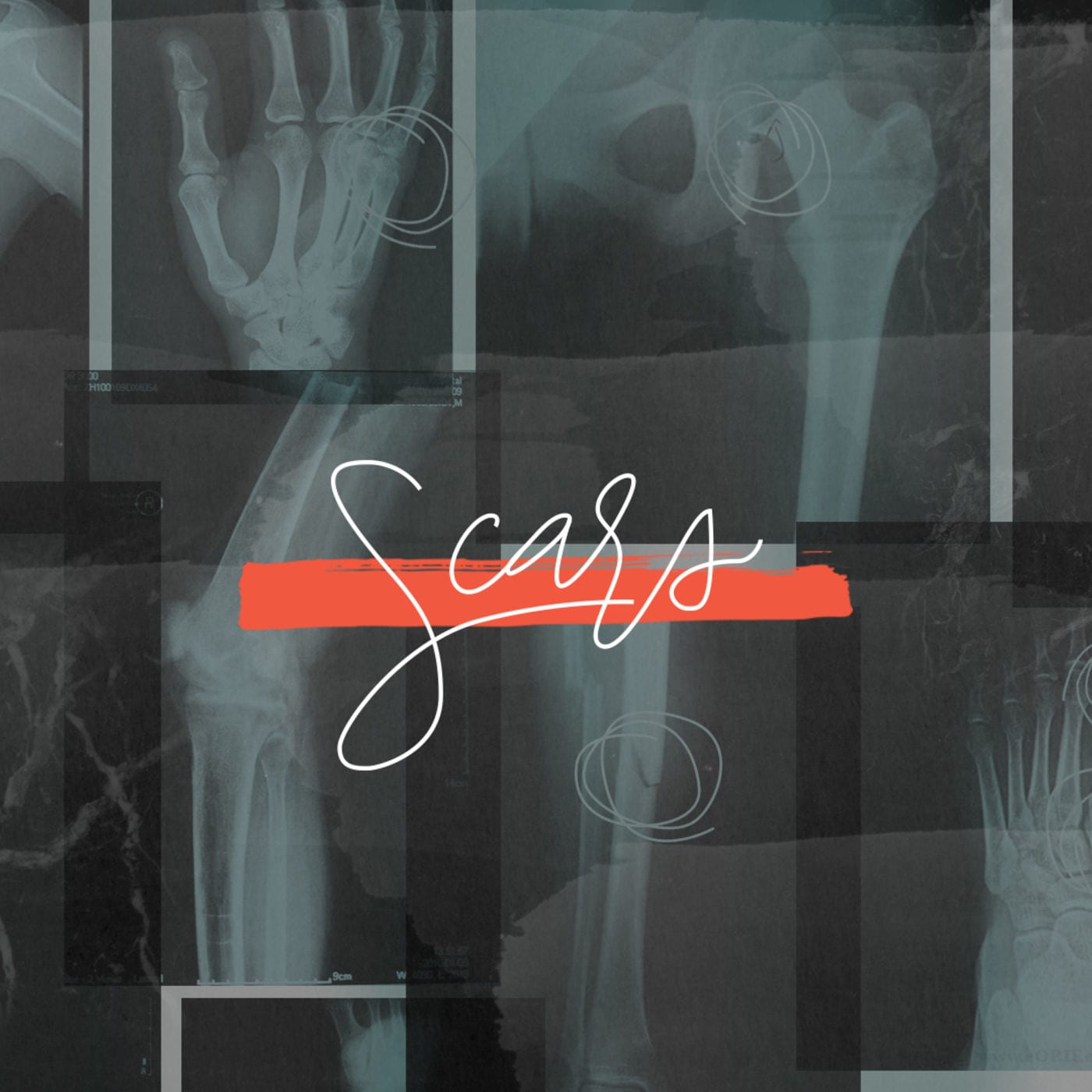 Scars